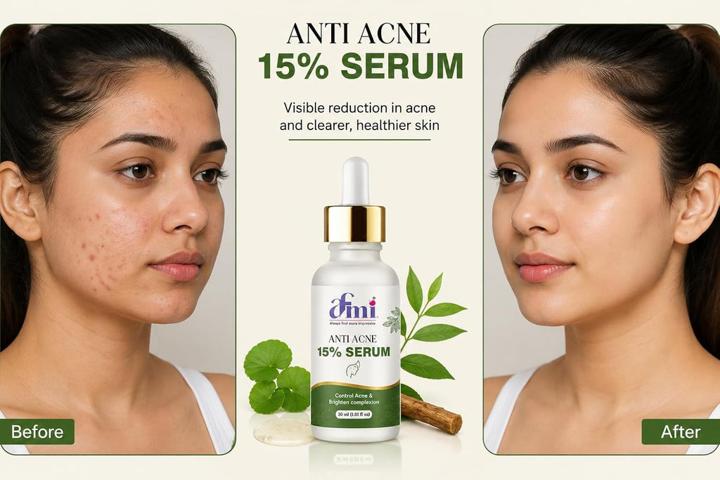 AFMI Anti Acne Face Serum for Oily & Acne-Prone Skin | Lightweight Daily Use Facial Serum with Hydrating Formula | Non-Sticky Skin Care Serum for Men & Women | 30 ml